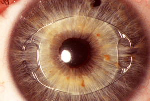 Новые возможности для пациентов с катарактой и астигматизмом